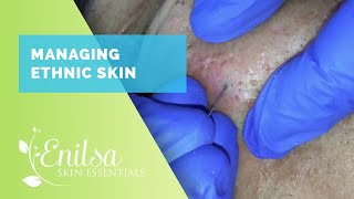 Managing Ethnic skin (Extractions part 2)