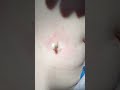 A Silkworm Popped Out From His Skin! | CONTOUR DERMATOLOGY