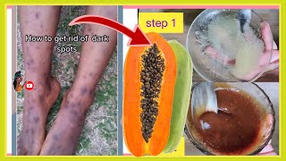 Only 8 days! How to remove Dark spots on legs,Scar, Mosquito Bites, Hyperpigmentation on legs fast