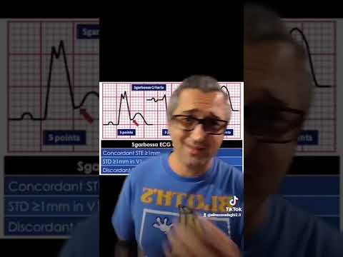 sgarbossa criteria made easy