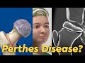 Perthes Disease Legg Calve Perthes Disease In Children