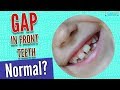 Do all babies have a gap in their front teeth ?
