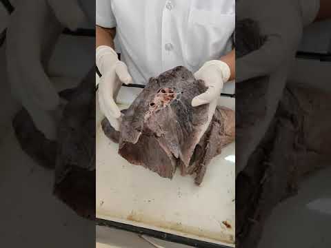 Lung Borders and Surfaces