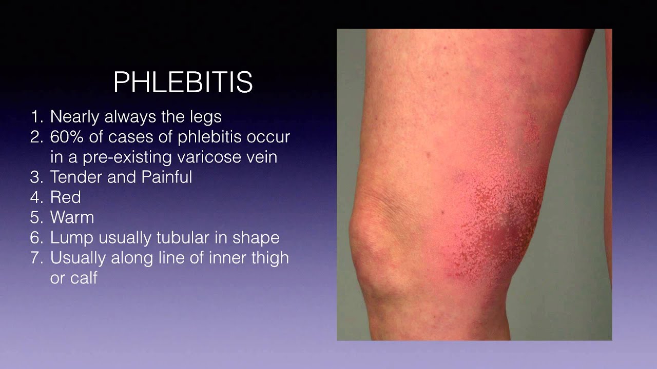 How To Know If You Have Phlebitis - A Guide to Signs and Symptoms - YouTube