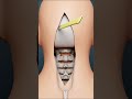 How Brain Clot Is Removed 3D Animation Shorts