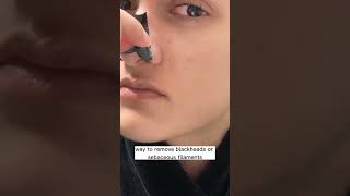 Stop using nose strips for blackheads