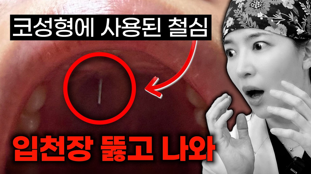 코성형에 철심이 왜 들어가나요? 감염문제 없나요?