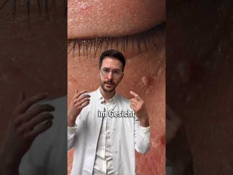 Fibrome & Stielwarzen: So werden sie richtig entfernt | DERMAFY #shorts