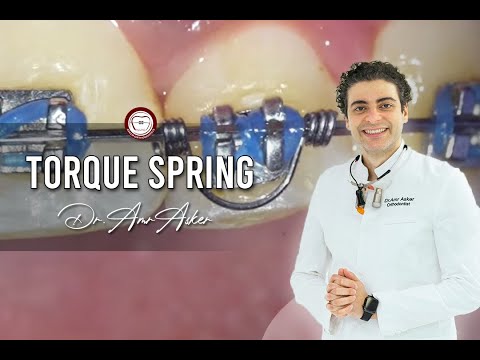 Orthodontic torque spring for negative torque Dr. Amr Asker