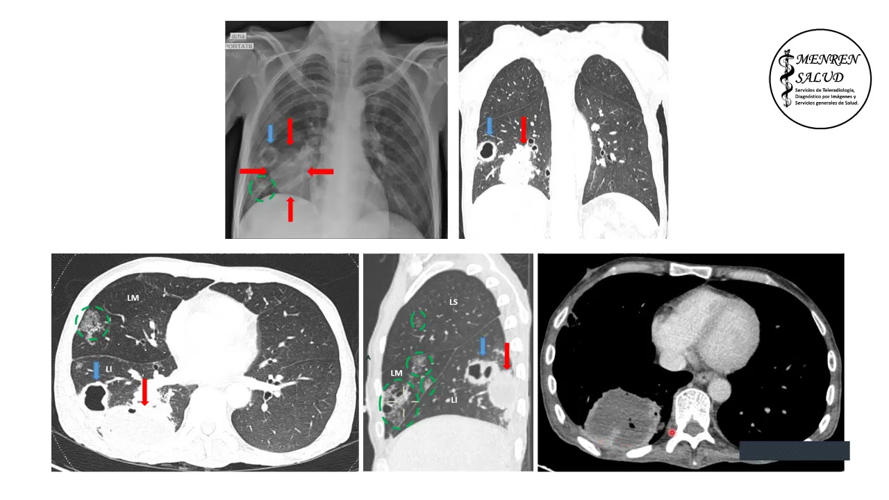 Caso clínico de neumonía necrotizante complicado con absceso pulmonar y cavitaciones pulmonares.