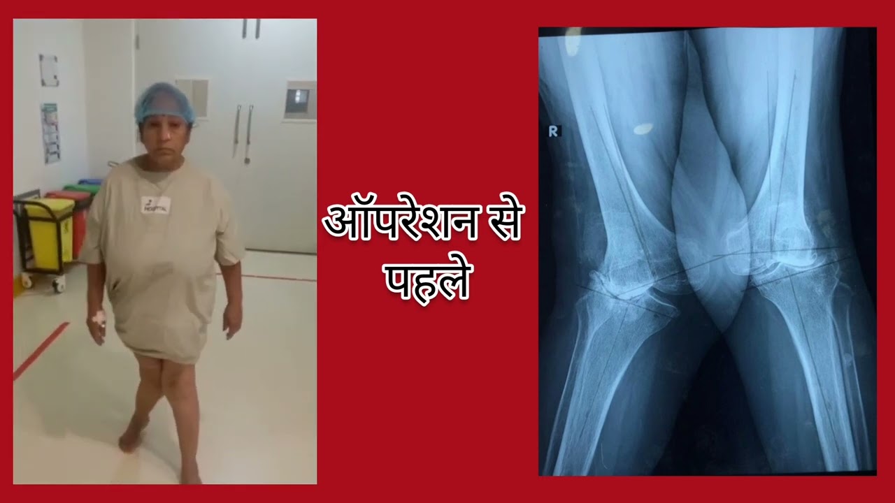 Total Knee Replacement (TKR) - pt name Mithlesh Devi #kneepain #drtarunsolanki