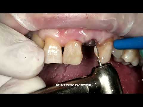 Немедленная имплантация Straumann BLX с Mucoderm и Xenoflex после удаления зуба