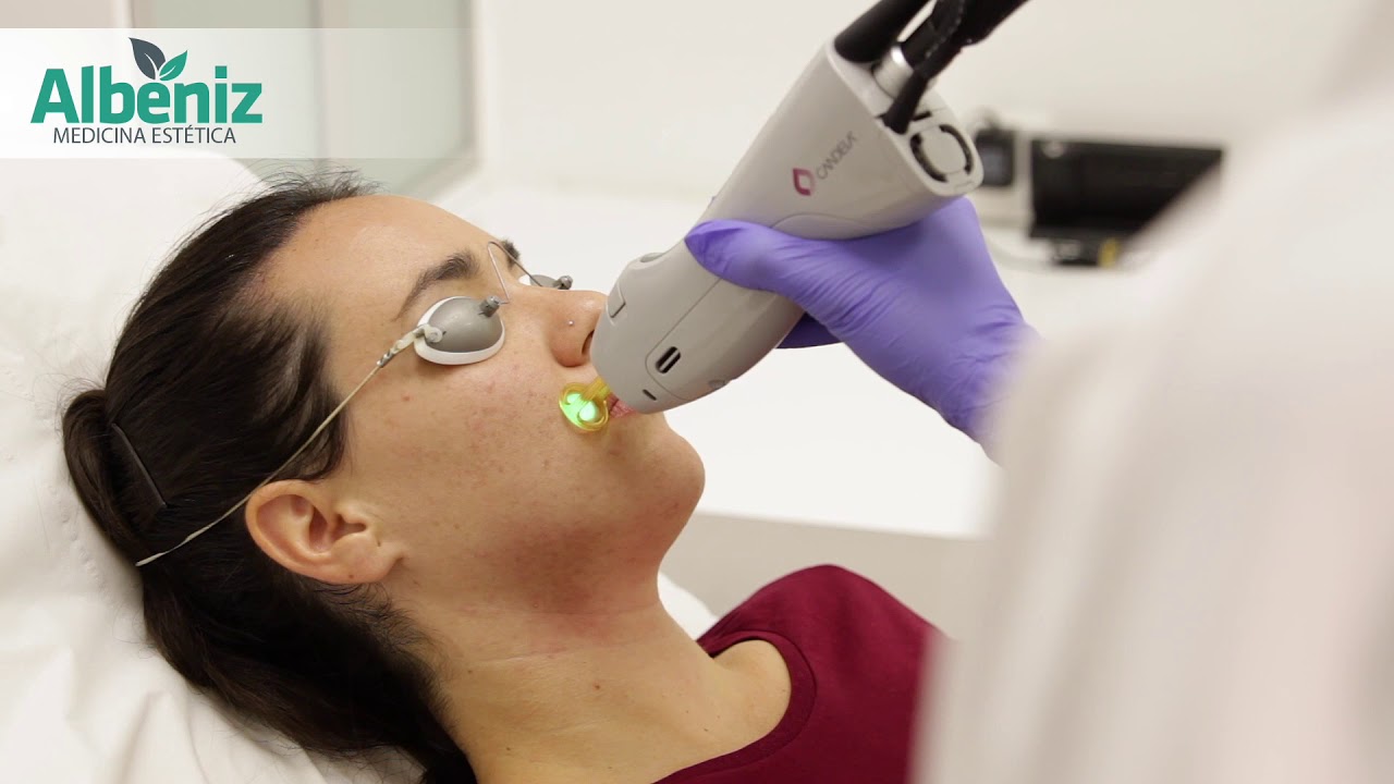 Watch Depilación Láser en la Cara | Albéniz Medicina Estética Granada Now Depilación Láser en la Cara | Albéniz Medicina Estética Granada