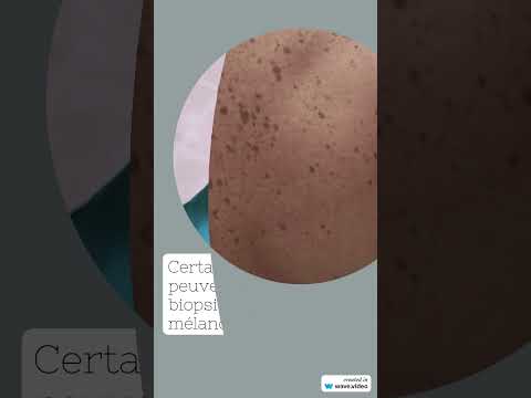 Vidéo : taches brunes — causes, diagnostic et traitement