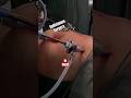 Gallstones Surgery In Surat I CHOLECYSTECTOMY I Cholelithiasis I Laparoscopic Pathri Operation
