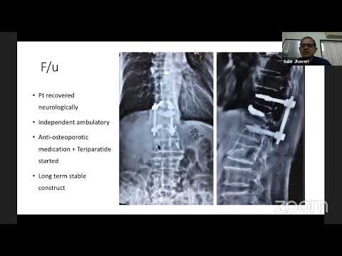 Webinar 17- Spine Trauma