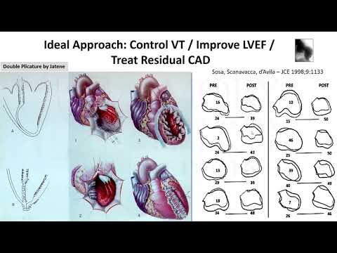 Catheter Ablation of Scar-Related Ventricular Tachycardia