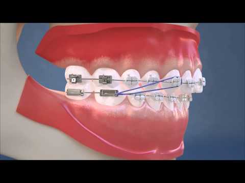 Class II Elastics - Lateral View (HD Edition)