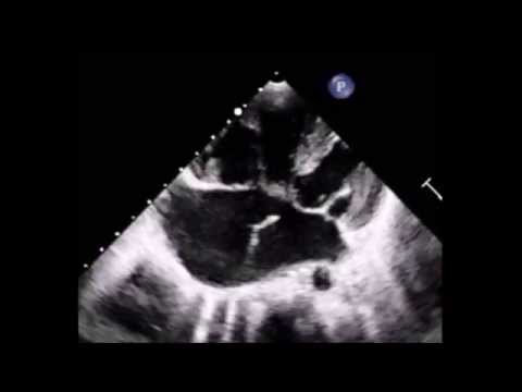 Complete atrioventricular canal