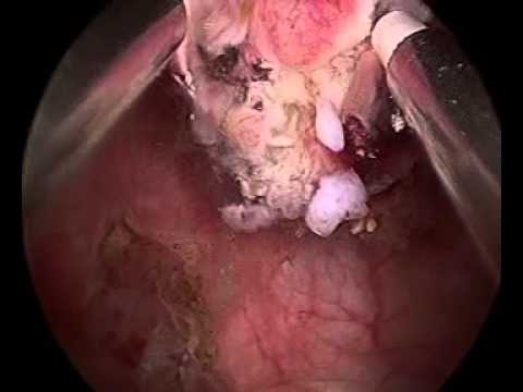 Resection of Small Bladder Tumor