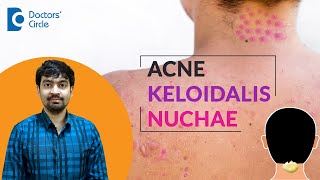Pimples on Neck/Back of head | Acne Keloidalis Nuchae Treatment - Dr.Rajdeep Mysore| Doctors