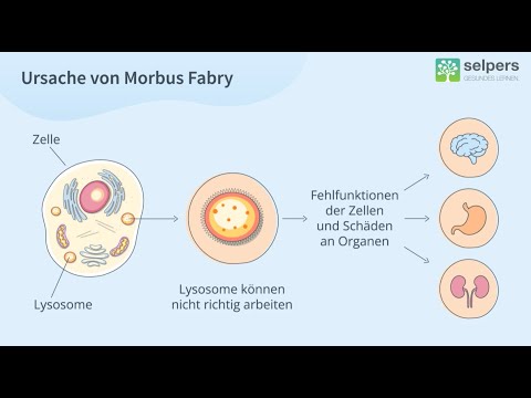 Was ist Morbus Fabry? (Experte informiert)