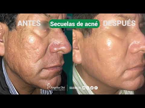 Antes y Después – Secuelas de Acné