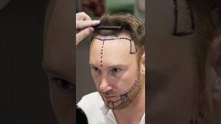 Cosmedica Clinic Hair Transplant in Turkey #shorts #hairtransplant #vi