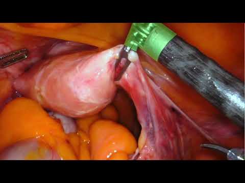 Robotic 4th Arm Uterus Manipulation