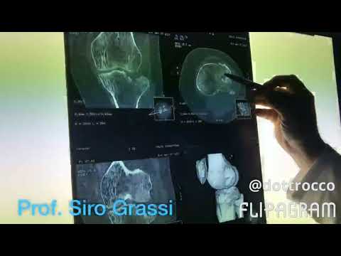 Come curare cervicale della colonna vertebrale ernia Osteocondrosi possibile fare il bagno sotto la doccia