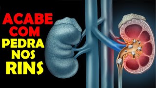 Pedra nos Rins - Sintomas, O Que Fazer e Alimentos Para Preveno