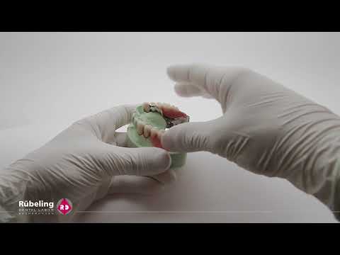 Ein- und ausgliedern einer Geschiebeprothese