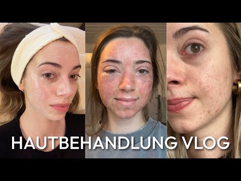 Was habe ich mir da angetan? (Co2 - Laserbehandlung) - VLOG