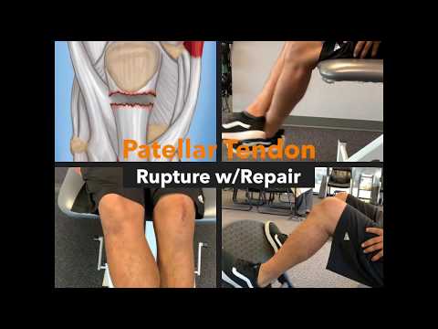 Patellar Tendon Tear Treatment - Exercises, FAQs & Case