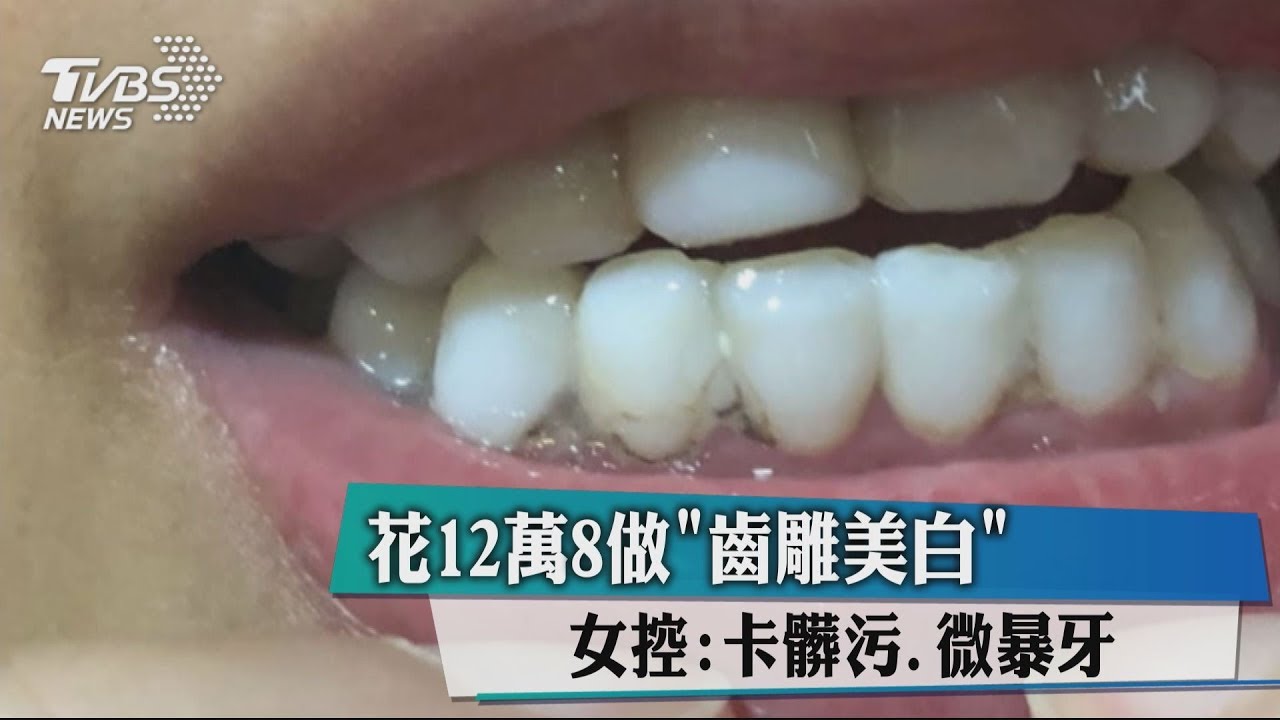花12萬8做齒雕美白 女控:卡髒污、微暴牙