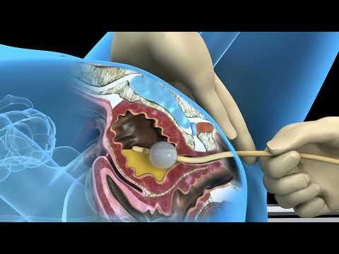 Foley catheter procedure for female bladder drainage - 3D animation Video