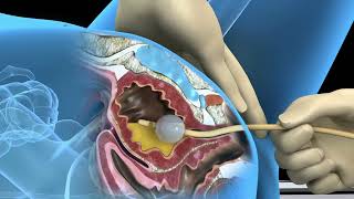 Foley catheter procedure for female bladder drainage - 3D animation