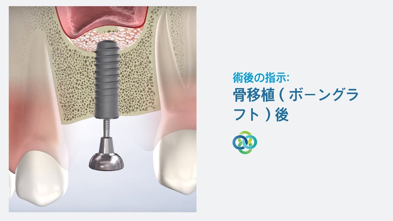 術後の指示：骨移植（ボーングラフト）後（Oral Surgery Hawaiiにて）