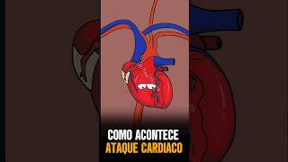 ATAQUE CARDIACO
