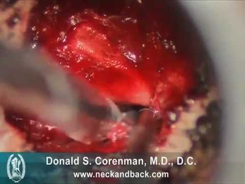 Posterior Cervical Foraminotomy 