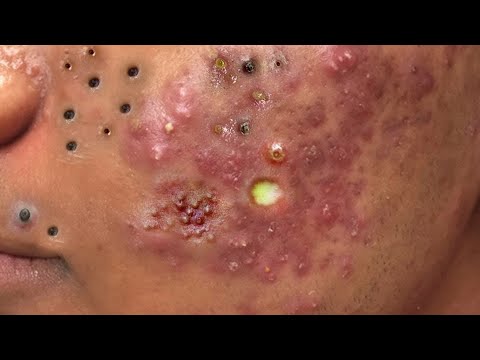 Super squeeze acne asmr #117  تلميع وتنظيف الجلد الطبيعي المدور