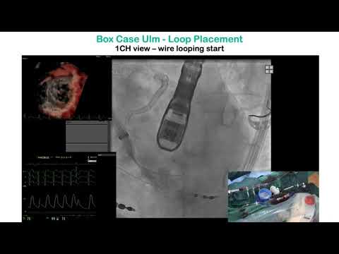 HighLife TSMVR study status and new developments - PCR London Valves 2021