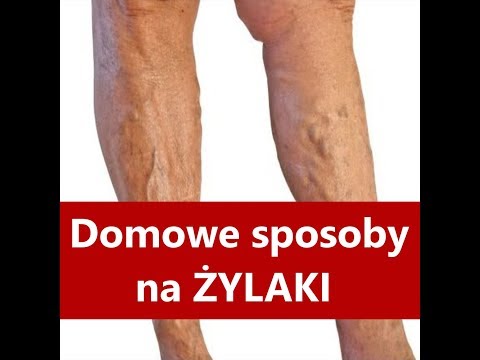 Maść szyszki na dużych palcach Płaski płaski valgus