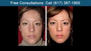 preview picture of video 'Fraxel Laser Treatments Boston - North End'