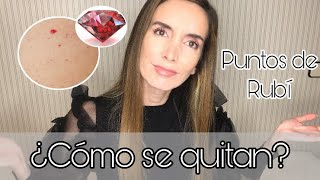 🔺Mi experiencia quitándome PUNTOS DE RUBÍ 🔺