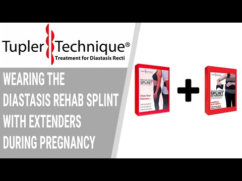 Wearing the Diastasis Rehab Splint with Extenders during Pregnancy - Julie Tupler, RN
