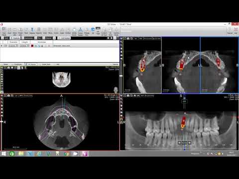 Implant Placement with Bone Density Assessment   X Mind Trium