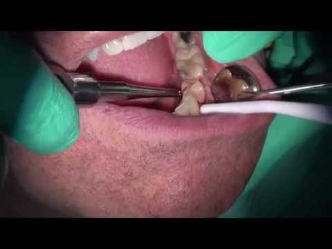 Методика реплантации зуба