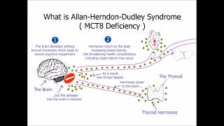 What is Allan-Herndon-Dudley syndrome (MCT8 deficiency)