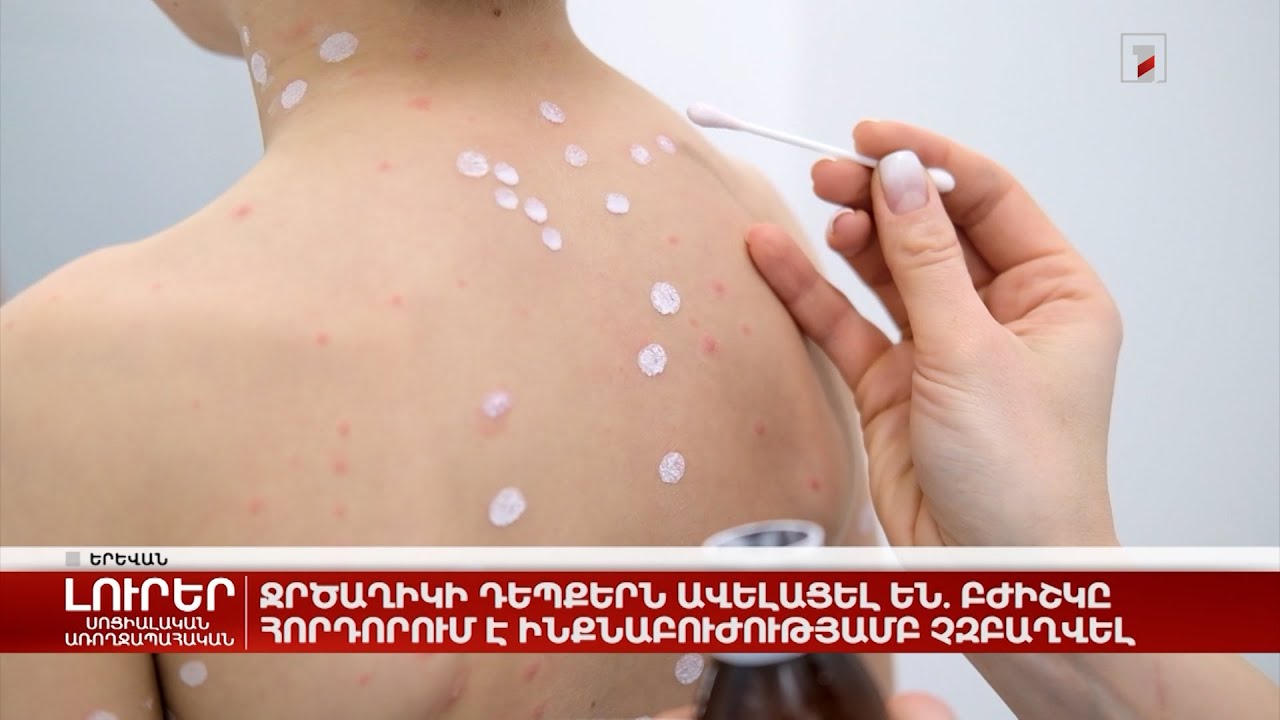 Ջրծաղիկի դեպքերն ավելացել են. բժիշկը հորդորում է ինքնաբուժությամբ չզբաղվել